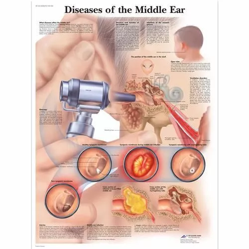 3B Scientific Diseases of the Middle Ear Chart