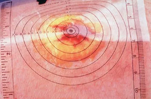 AliMed Plastic Wound Measuring Guide