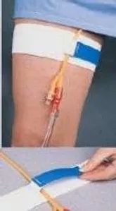 Cath-MateII Leg Stap
