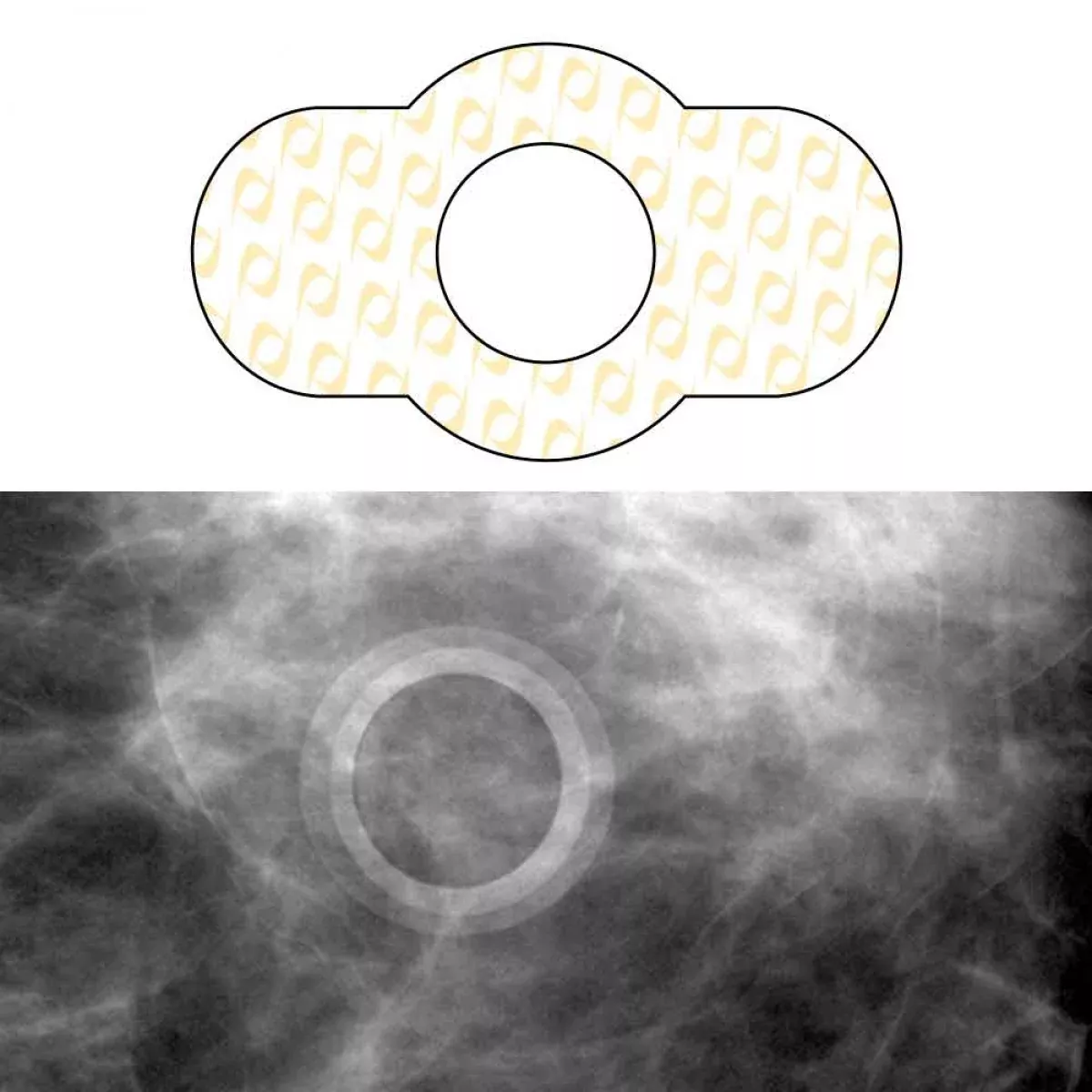 Spee-D-Ring Mammography Skin Marker Mole Radiolucent No Burnout Super-Stretchy 1/2" Inner Diameter - 100 Per Box